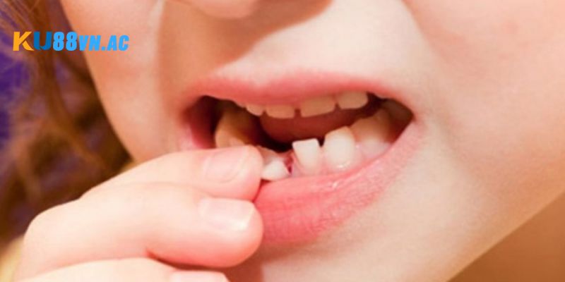 Mơ Rụng Răng Cửa Đánh Con Gì ? - Giải Đáp Giấc Mơ Tại Ku88 3 nằm mơ rụng răng cửa đánh con gì